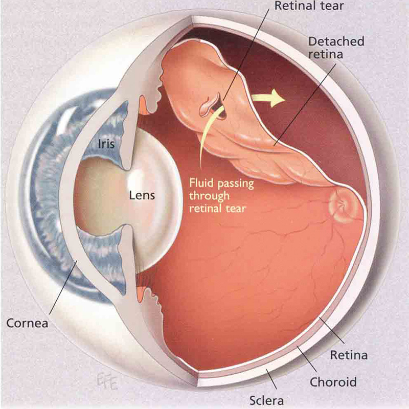 Descolamento da Retina  Oculari Hospital Oftalmológico